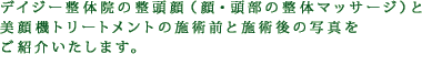 デイジー整体院の整頭顔（顔・頭部の整体マッサージ）と美顔機トリートメントの施術前と施術後の写真をご紹介いたします。